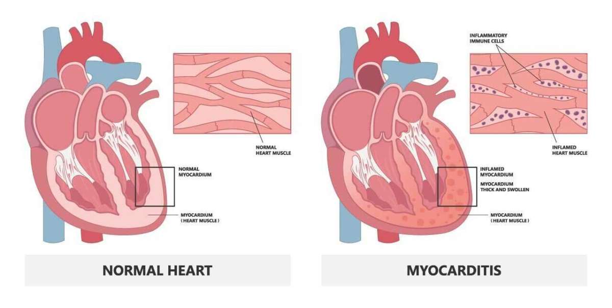 Myocarditis In Kids Under 18